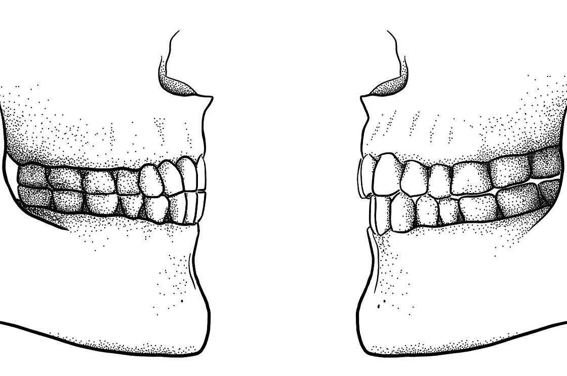 Ортогнатический прикус стоматология